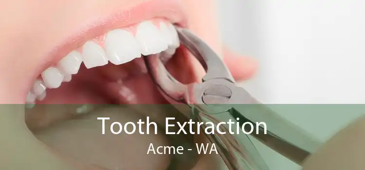 Tooth Extraction Acme - WA