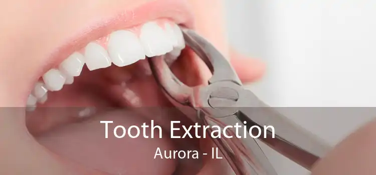 Tooth Extraction Aurora - IL