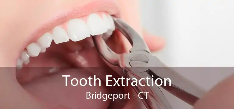 Tooth Extraction Bridgeport - CT