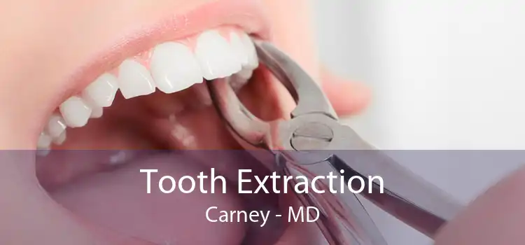 Tooth Extraction Carney - MD