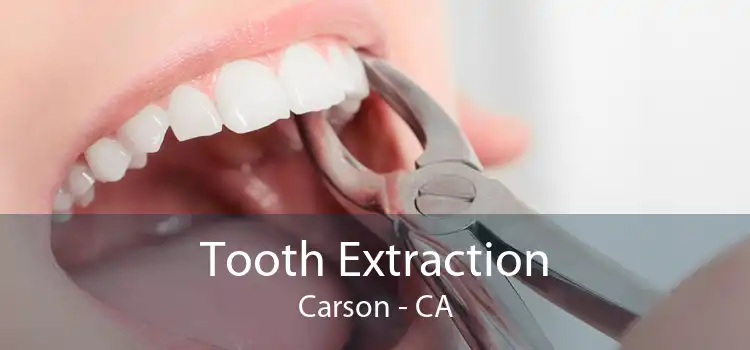 Tooth Extraction Carson - CA