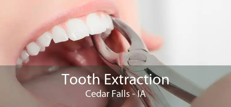 Tooth Extraction Cedar Falls - IA