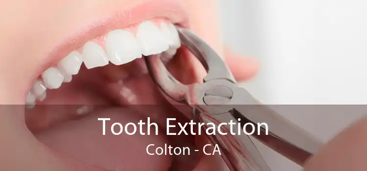 Tooth Extraction Colton - CA