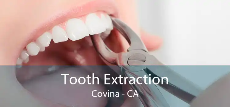 Tooth Extraction Covina - CA