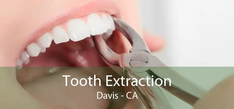 Tooth Extraction Davis - CA