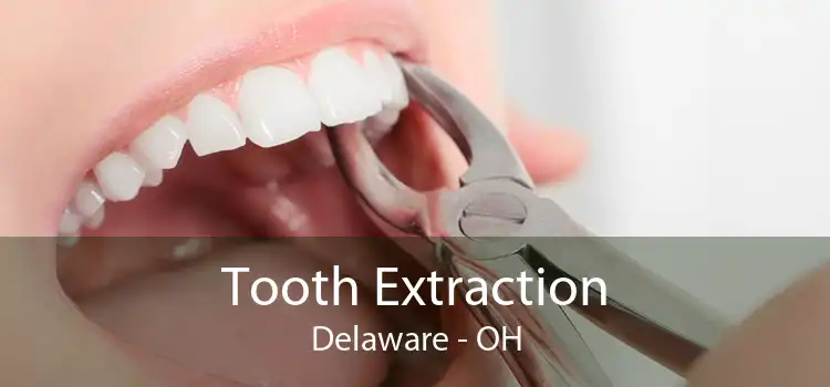 Tooth Extraction Delaware - OH