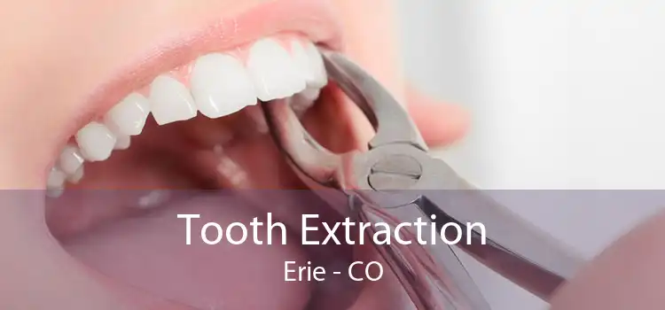 Tooth Extraction Erie - CO