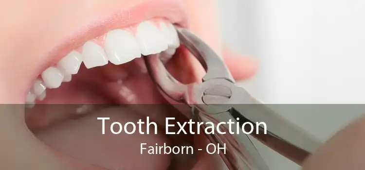 Tooth Extraction Fairborn - OH