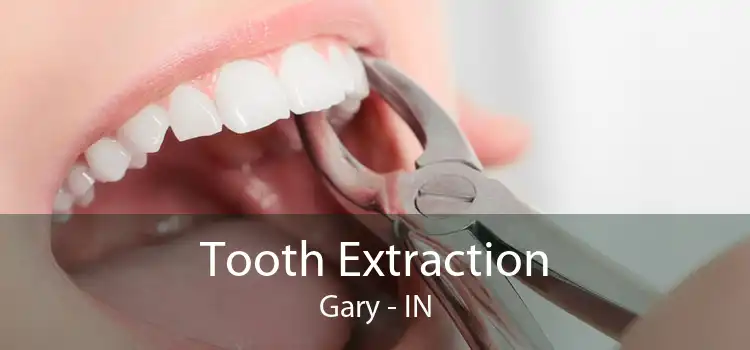 Tooth Extraction Gary - IN