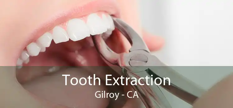 Tooth Extraction Gilroy - CA