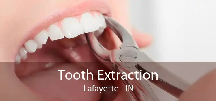 Tooth Extraction Lafayette - IN