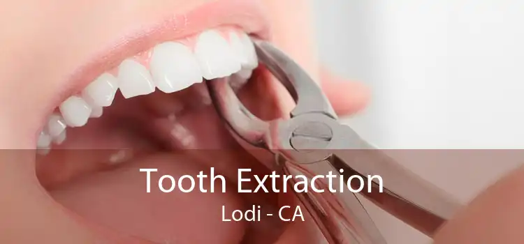 Tooth Extraction Lodi - CA