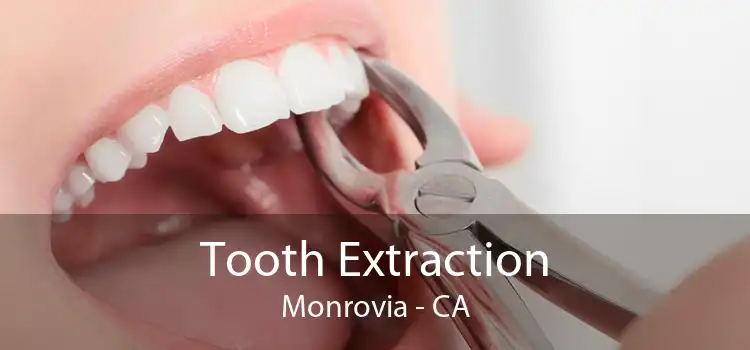 Tooth Extraction Monrovia - CA