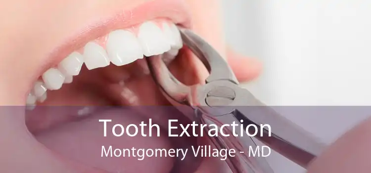 Tooth Extraction Montgomery Village - MD