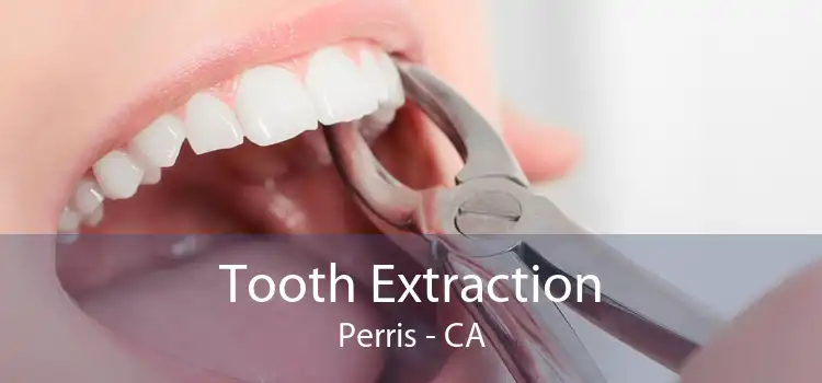 Tooth Extraction Perris - CA