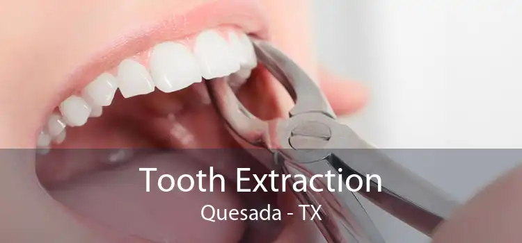 Tooth Extraction Quesada - TX