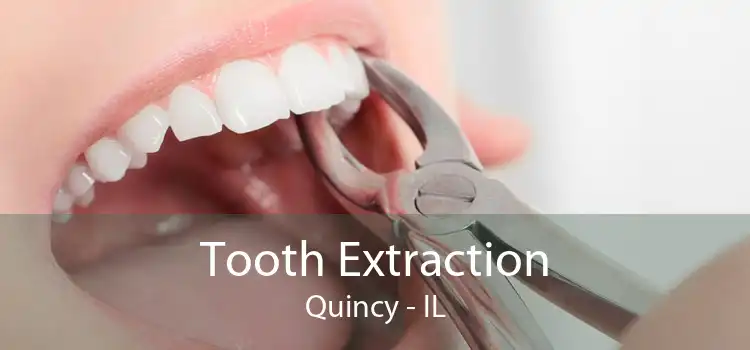 Tooth Extraction Quincy - IL