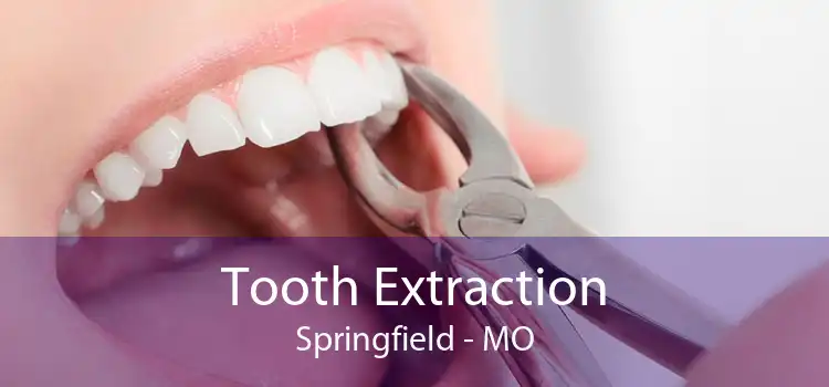 Tooth Extraction Springfield - MO