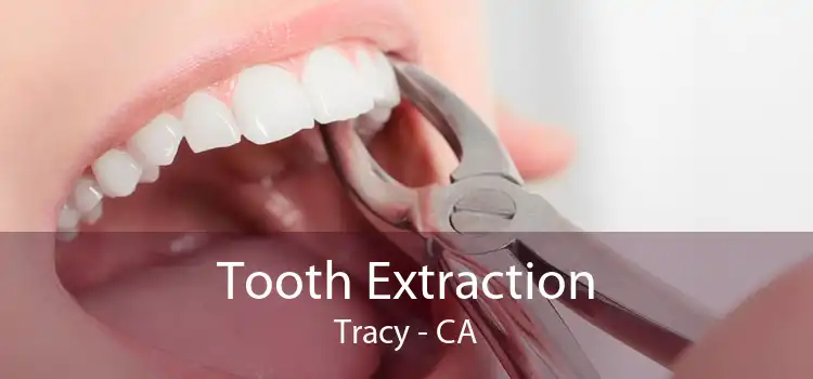 Tooth Extraction Tracy - CA