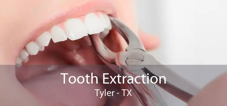 Tooth Extraction Tyler - TX