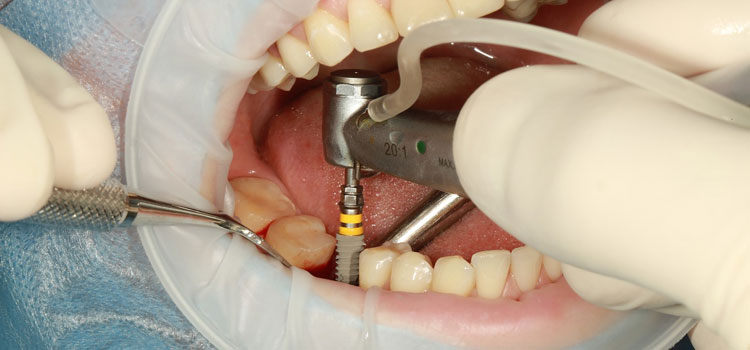 Cosmetic Dental Implants in Aberdeen, MD