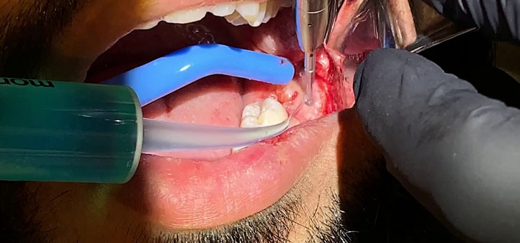 Emergency Tooth Extraction in Alpharetta, GA
